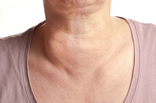 A smooth swelling at the lower front right side of a woman's neck. Shown on white skin.