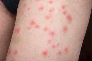 Close-up of bedbug bites on white skin. There are over 20 small red spots on the skin where bedbugs have bitten the skin.