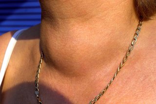 A large swelling across the lower front of a woman's neck. Shown on light brown skin.