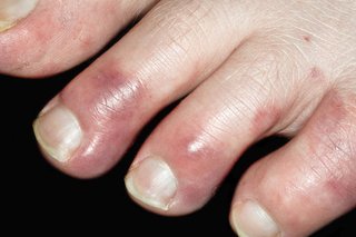 Chilblains on the toes of a person with white skin. The tips of the toes are red.