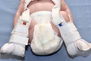 A baby wearing a fabric harness around their feet and legs. The harness is holding the baby's hips in an open position.