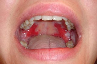 Pemphigus vulgaris inside a person's mouth. There are red, sore-looking patches covering the roof of the mouth.