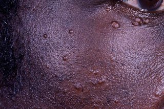 A close-up of the side of a person's face showing raised spots near the eye (shown on dark brown skin).