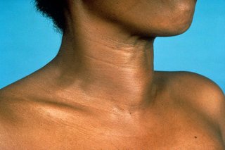 An egg-shaped lump on the lower front of a woman's neck. Shown on black skin.