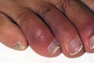 Chilblains on the toes of a person with dark brown skin. The tips of the toes are slightly red and purple.