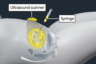 Diagram showing an ultrasound scanner on the tummy guiding a thin needle into the womb, with the baby visible inside.