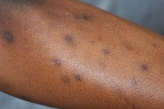 Close-up of bedbug bites on medium brown skin. There are around 10 spots where the skin is bitten. The spots are dark brown.